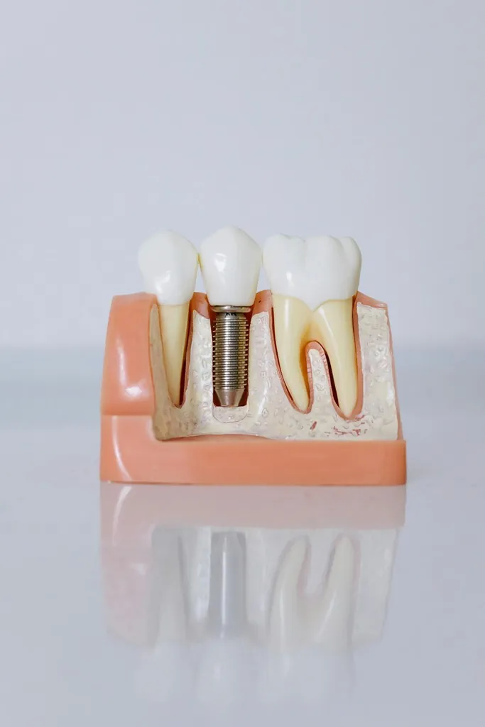 Dental implant with a natural-looking crown