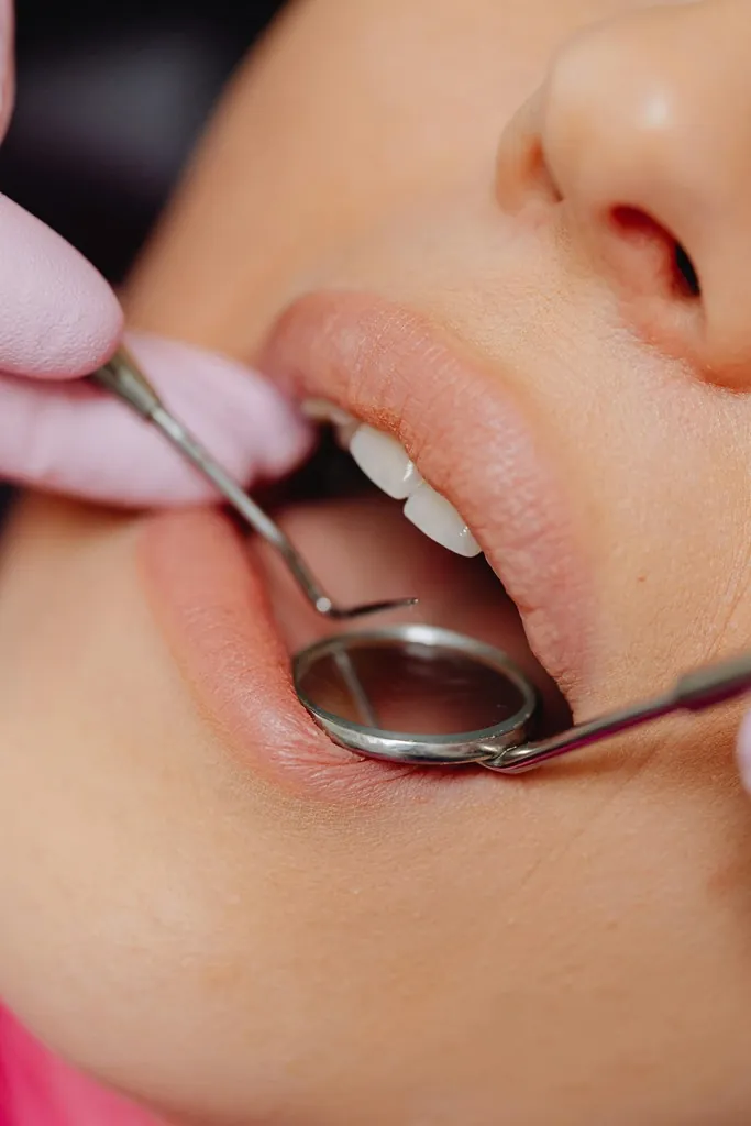 Tooth-coloured filling repair on a molar