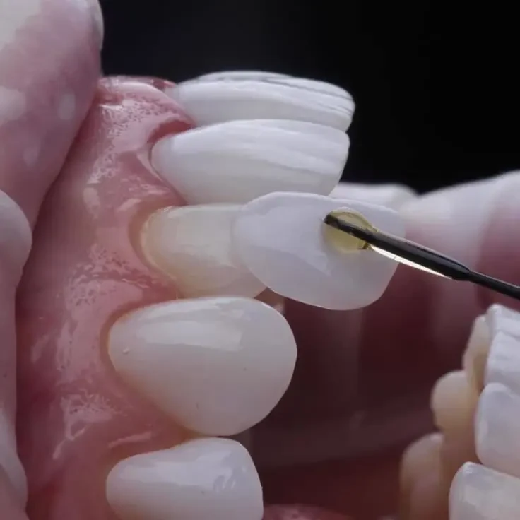 A thin porcelain veneer held on a dental instrument, being placed onto a front tooth